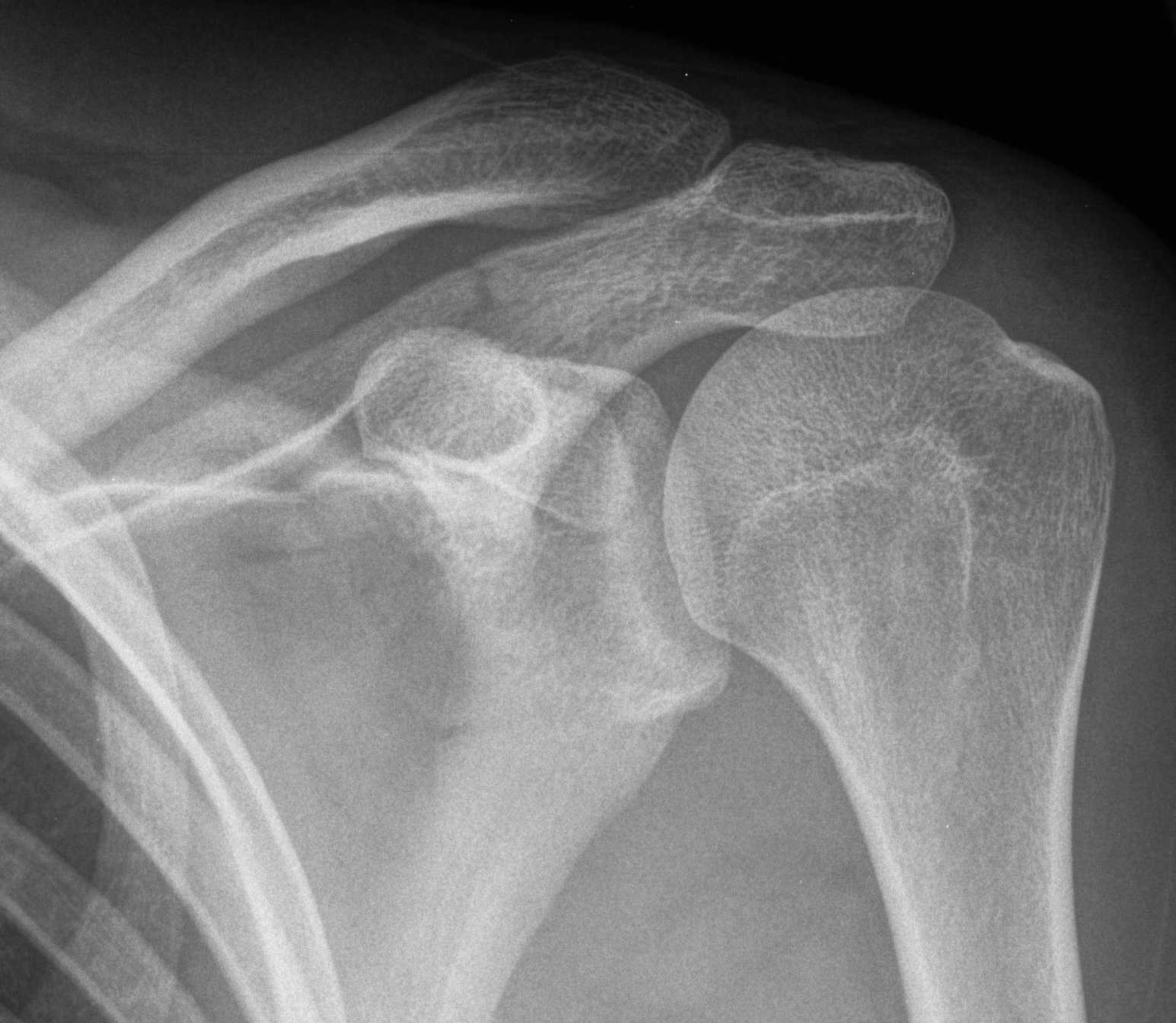 Glenoid & Scapula Fractures The Bone School